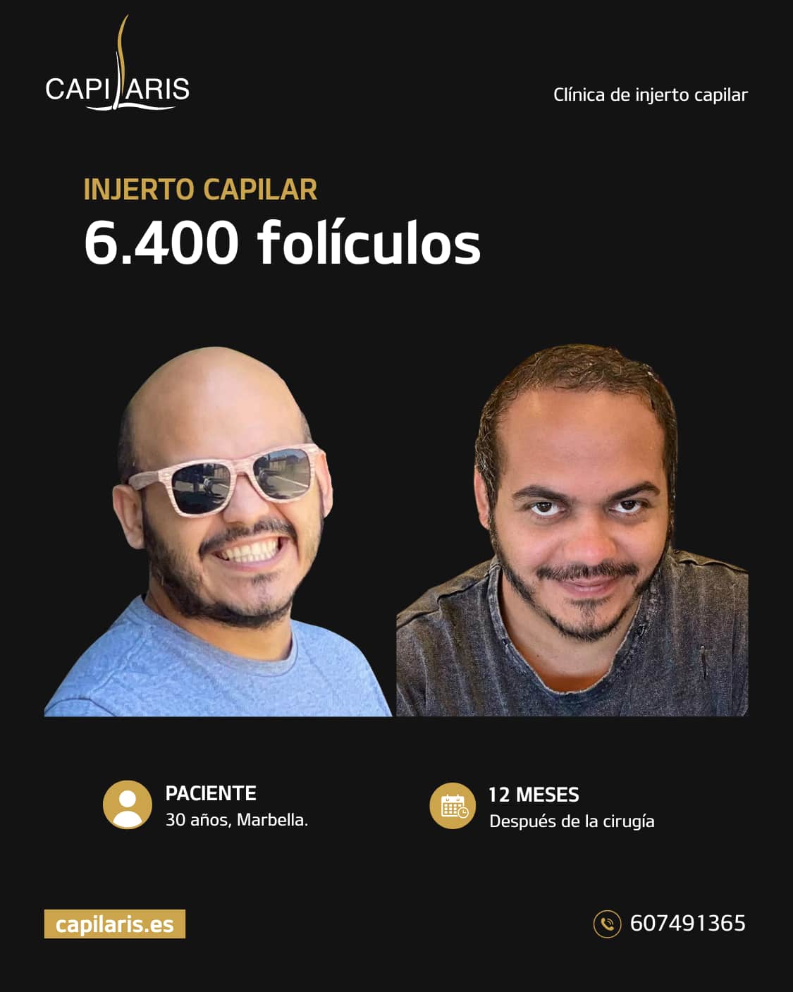 mesoterapia capilar marbella