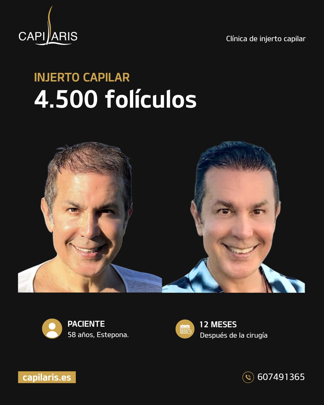 clinica injerto capilar marbella