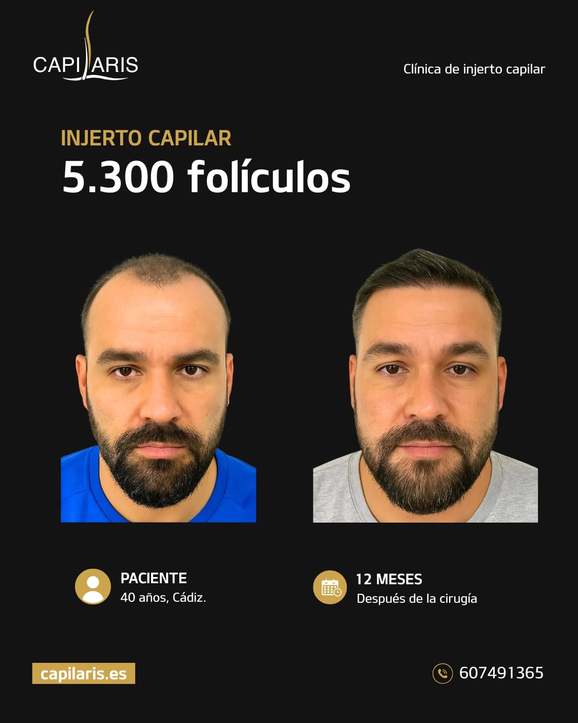 tratamiento capilar marbella