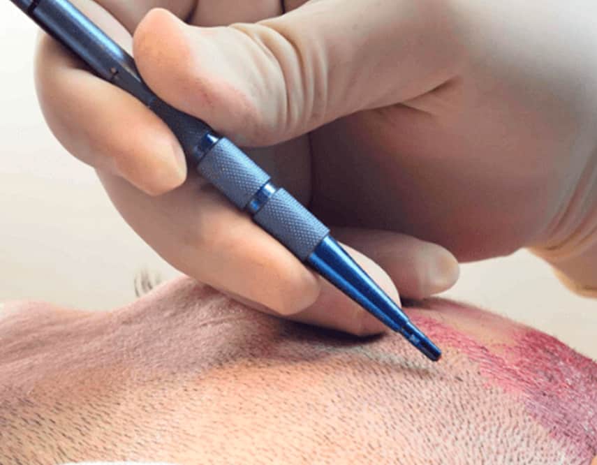 injerto de pelo marbella