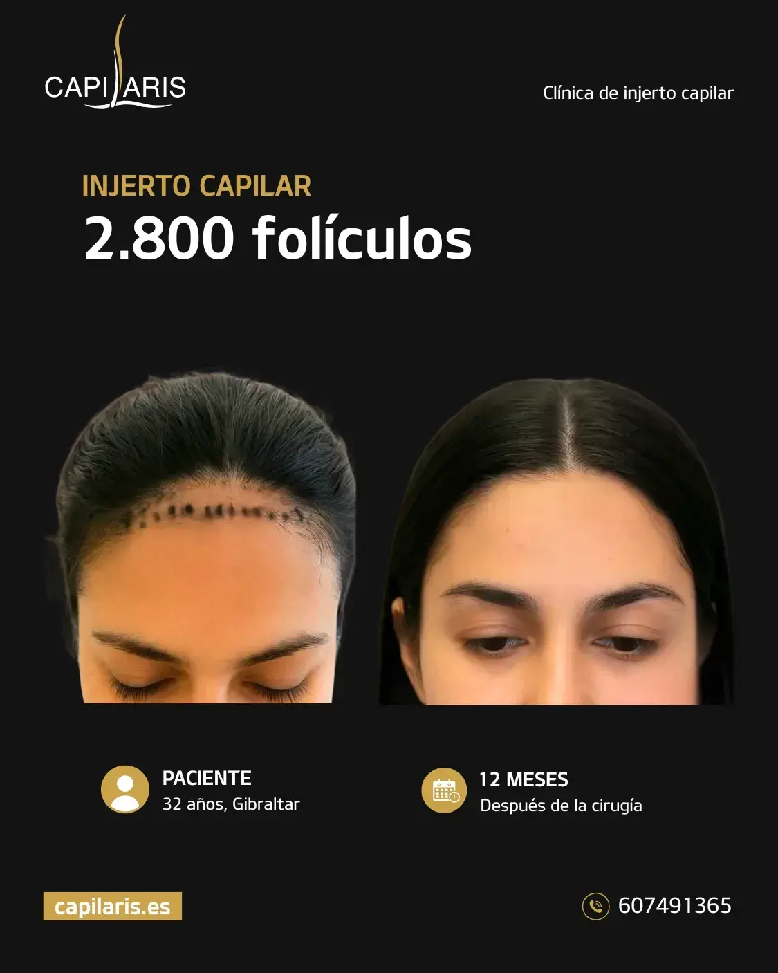 injerto capilar mujer marbella