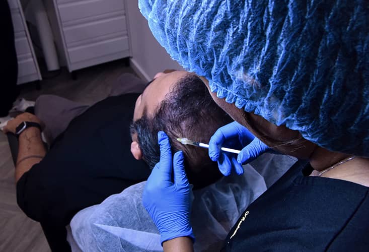 trasplante de pelo melilla