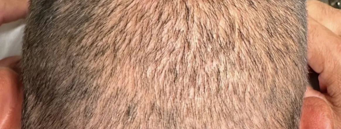 zona podre donante tratamiento granada