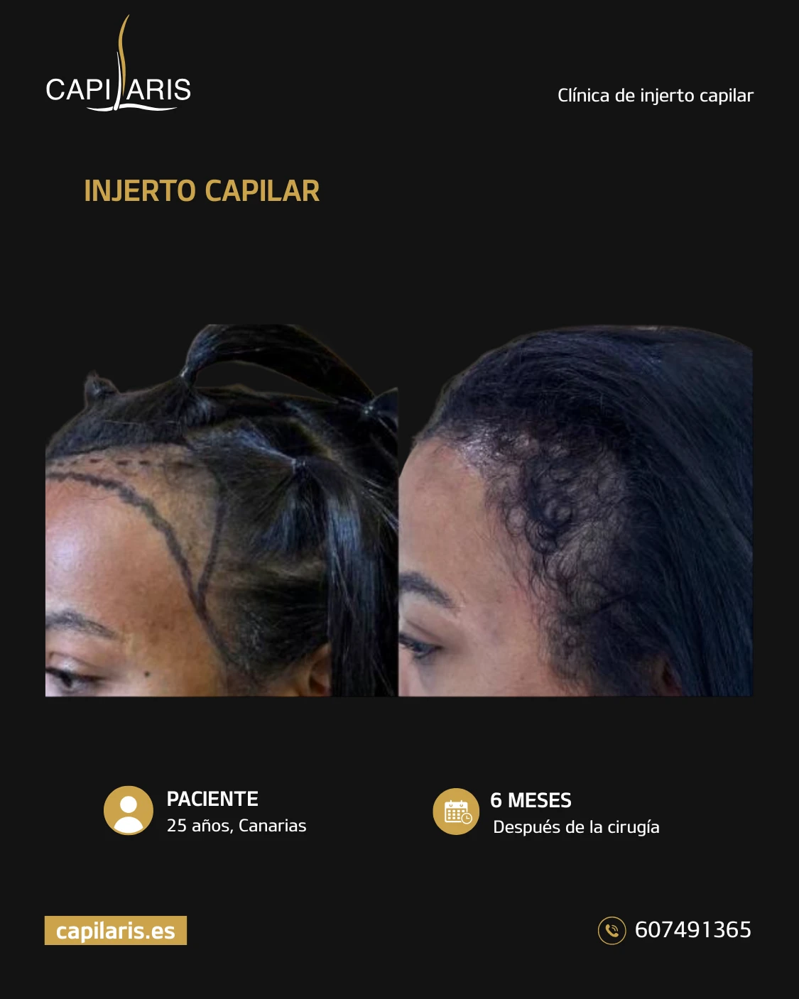 injerto capilar mujeres