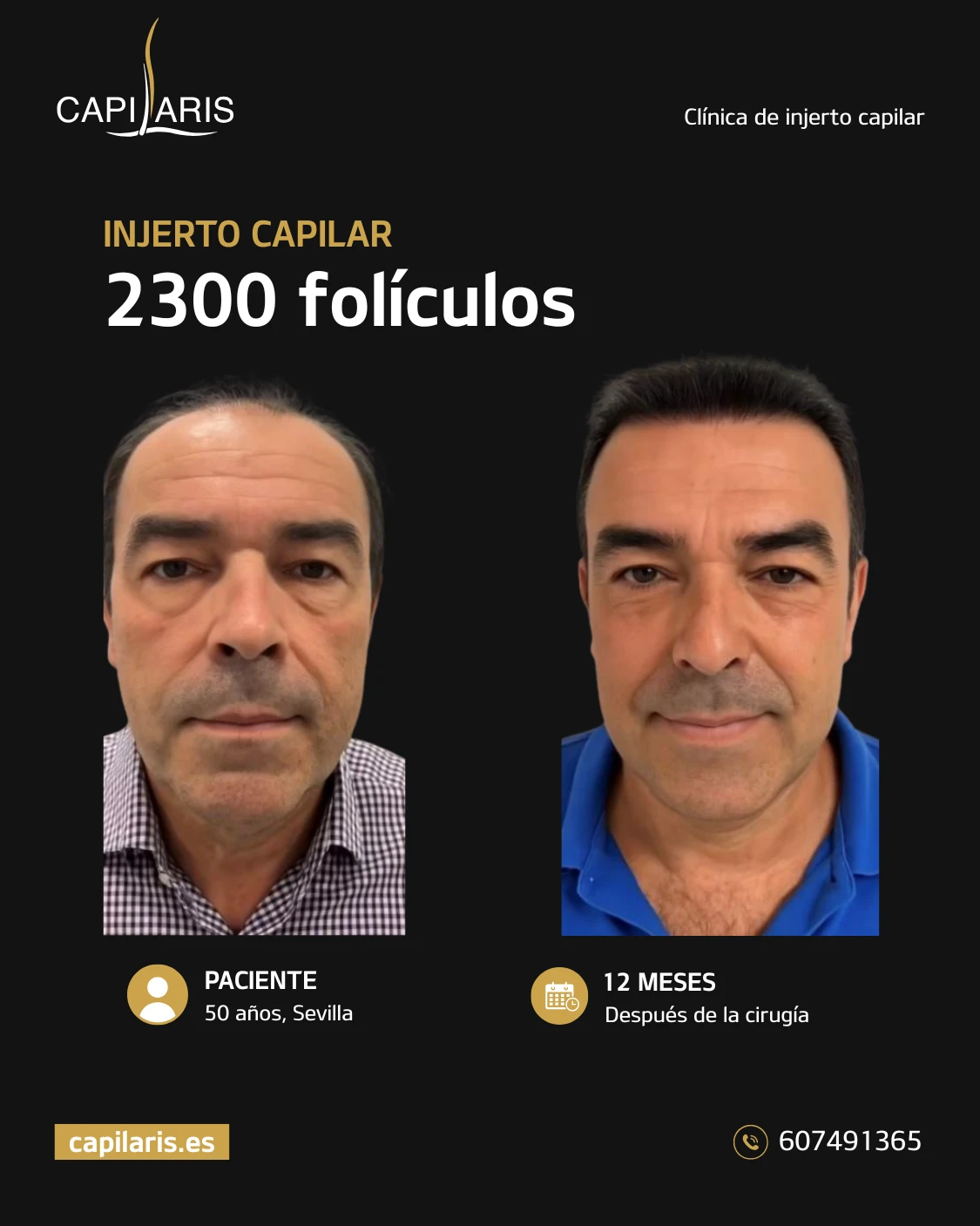 injerto capilar sin rapar opiniones