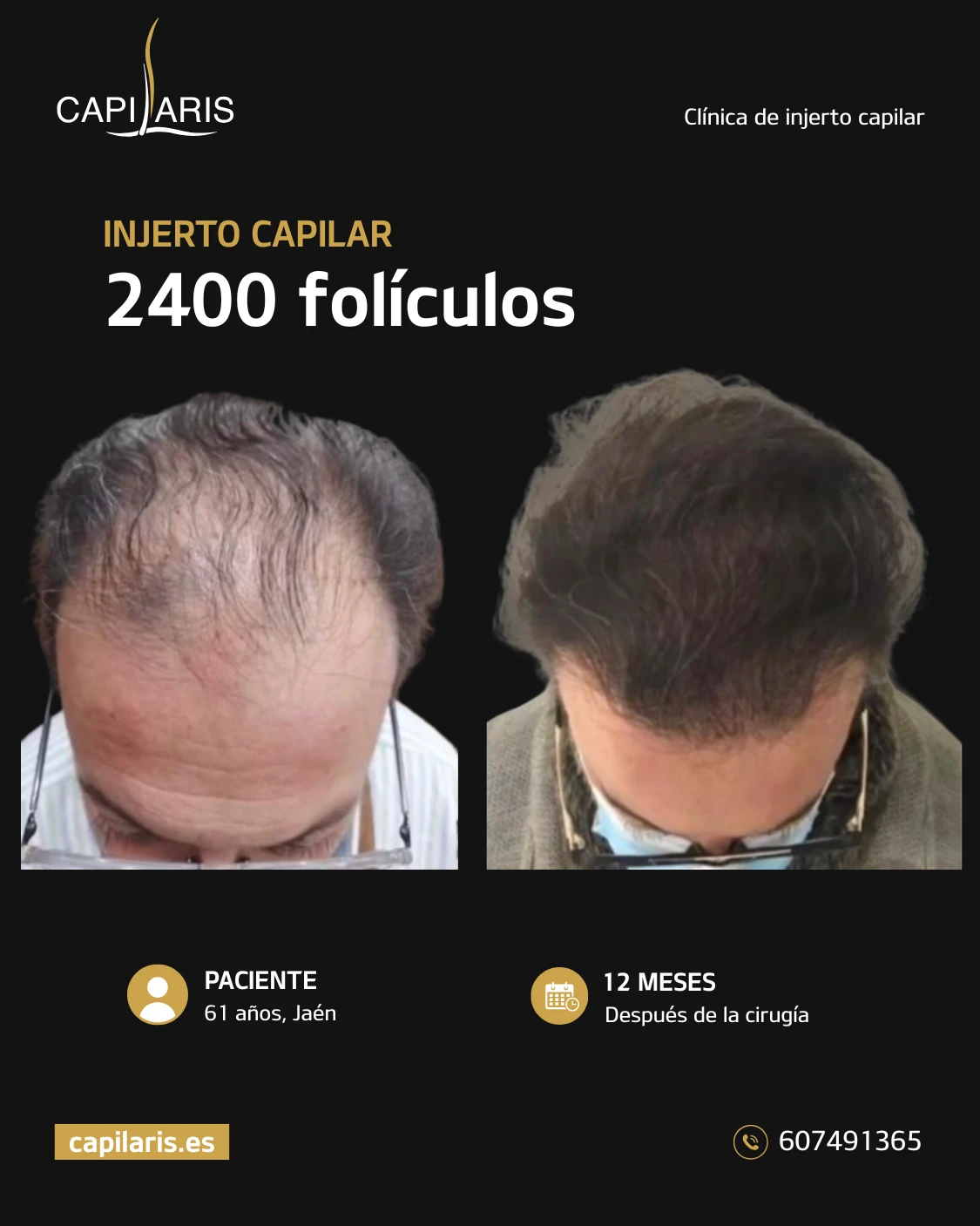 centro injerto capilar