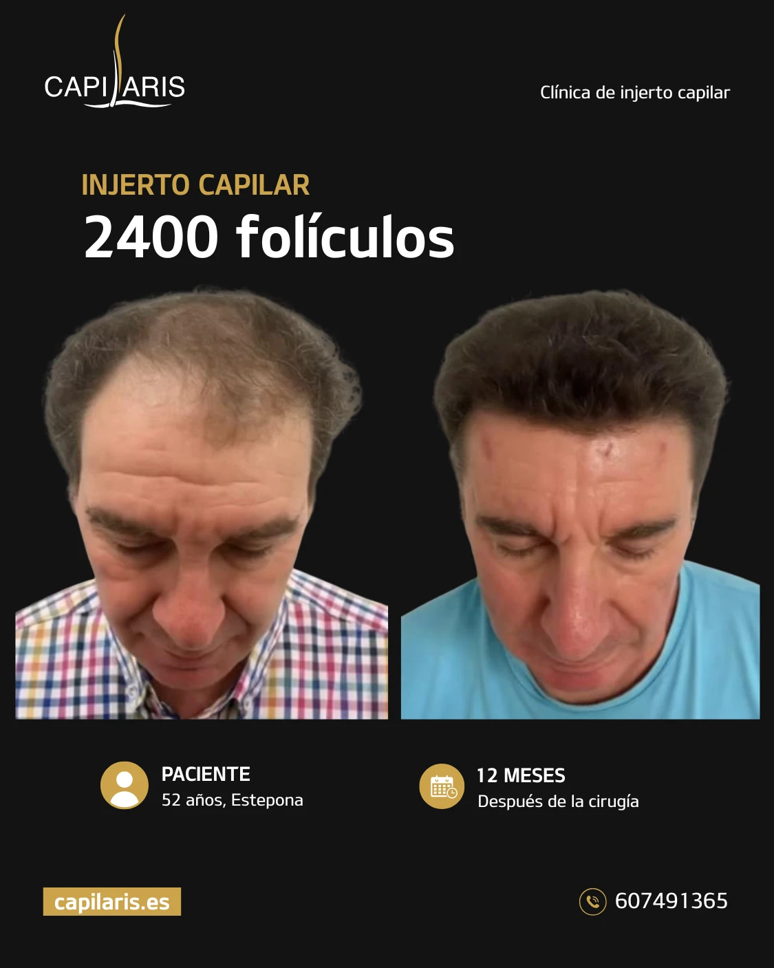 evolucion injerto capilar mes a mes