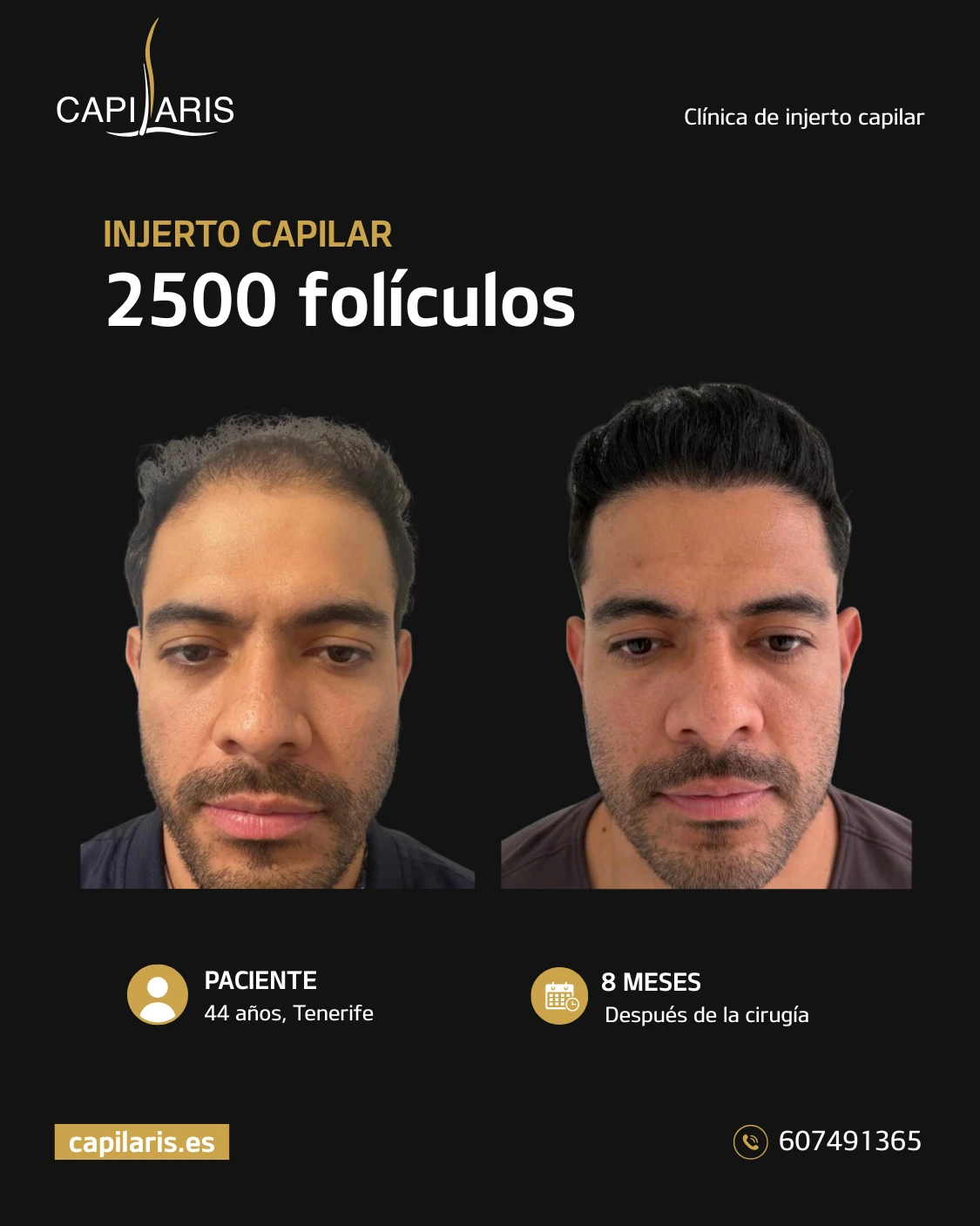 precio injerto capilar