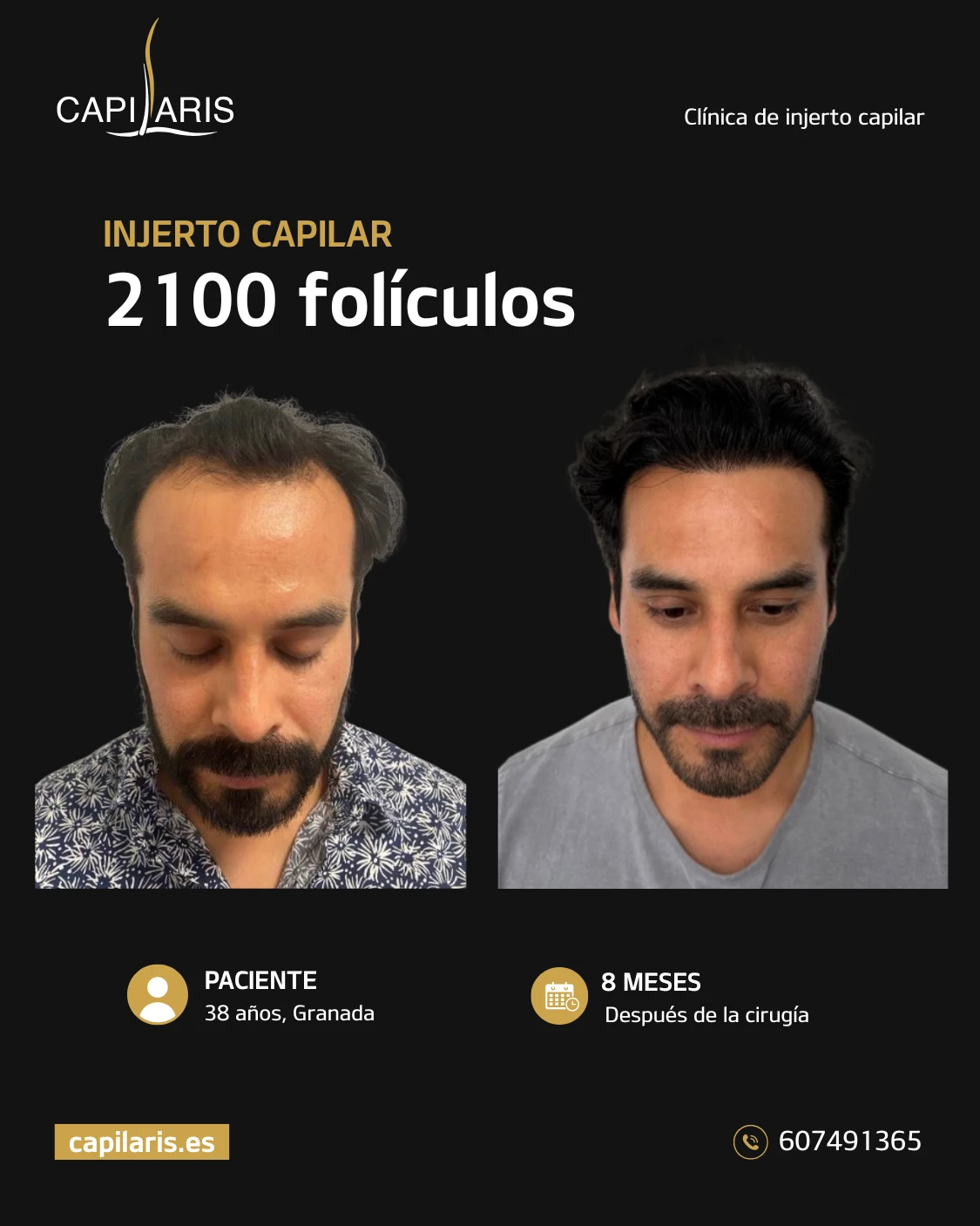 injerto capilar evolucion