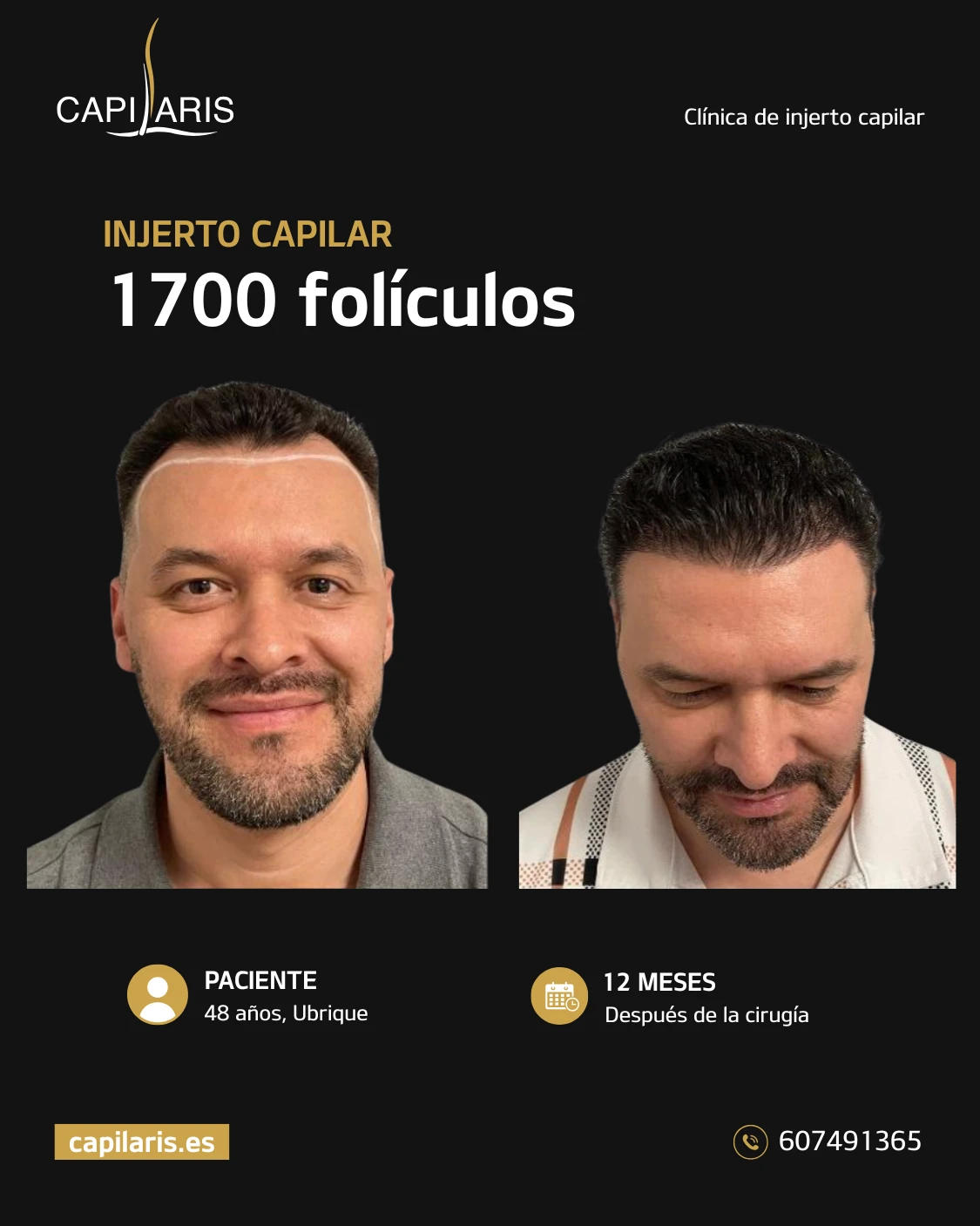 evolucion injerto capilar