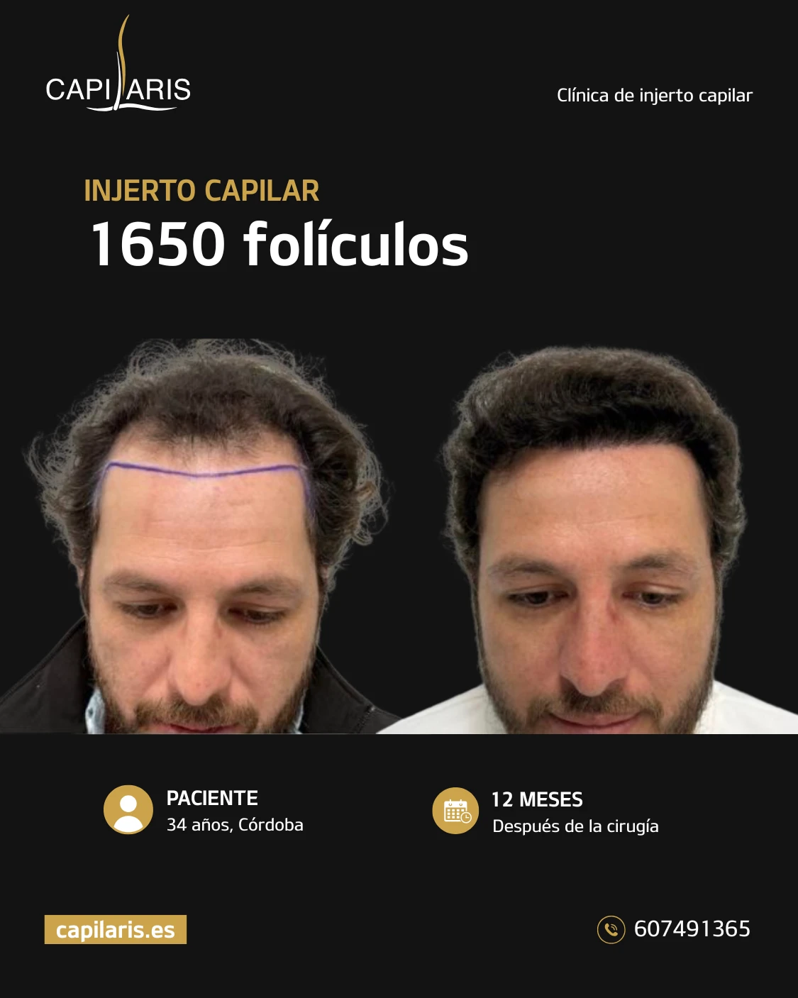 cuanto cuesta un injerto capilar