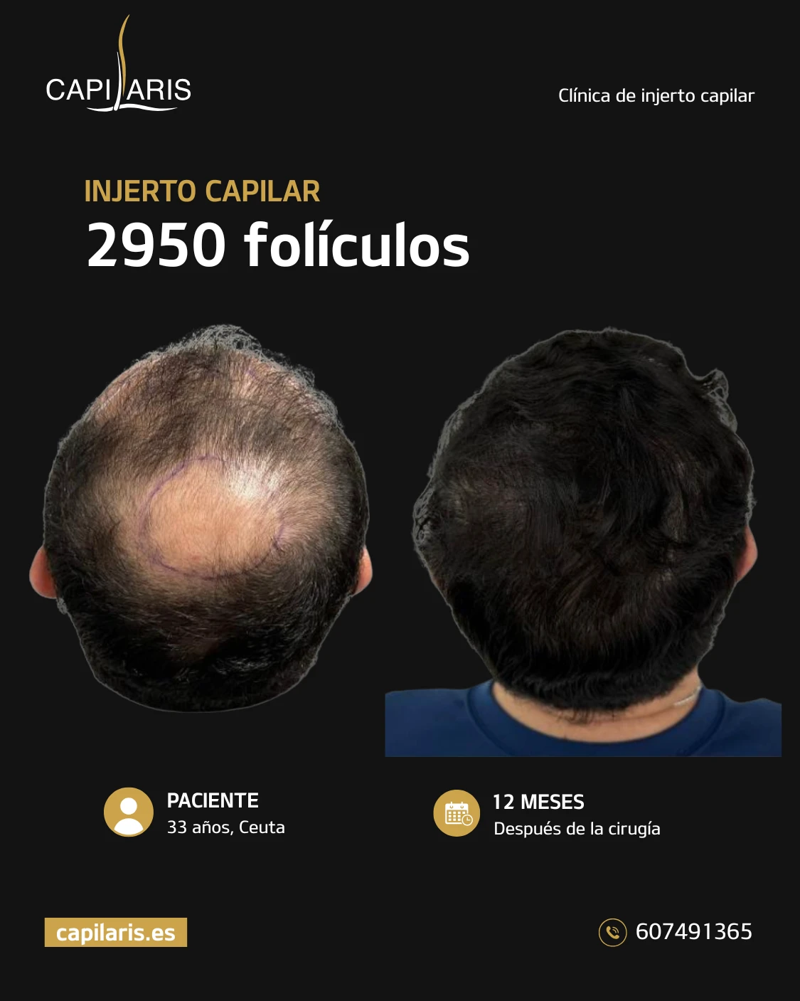 mejor clinica injerto capilar