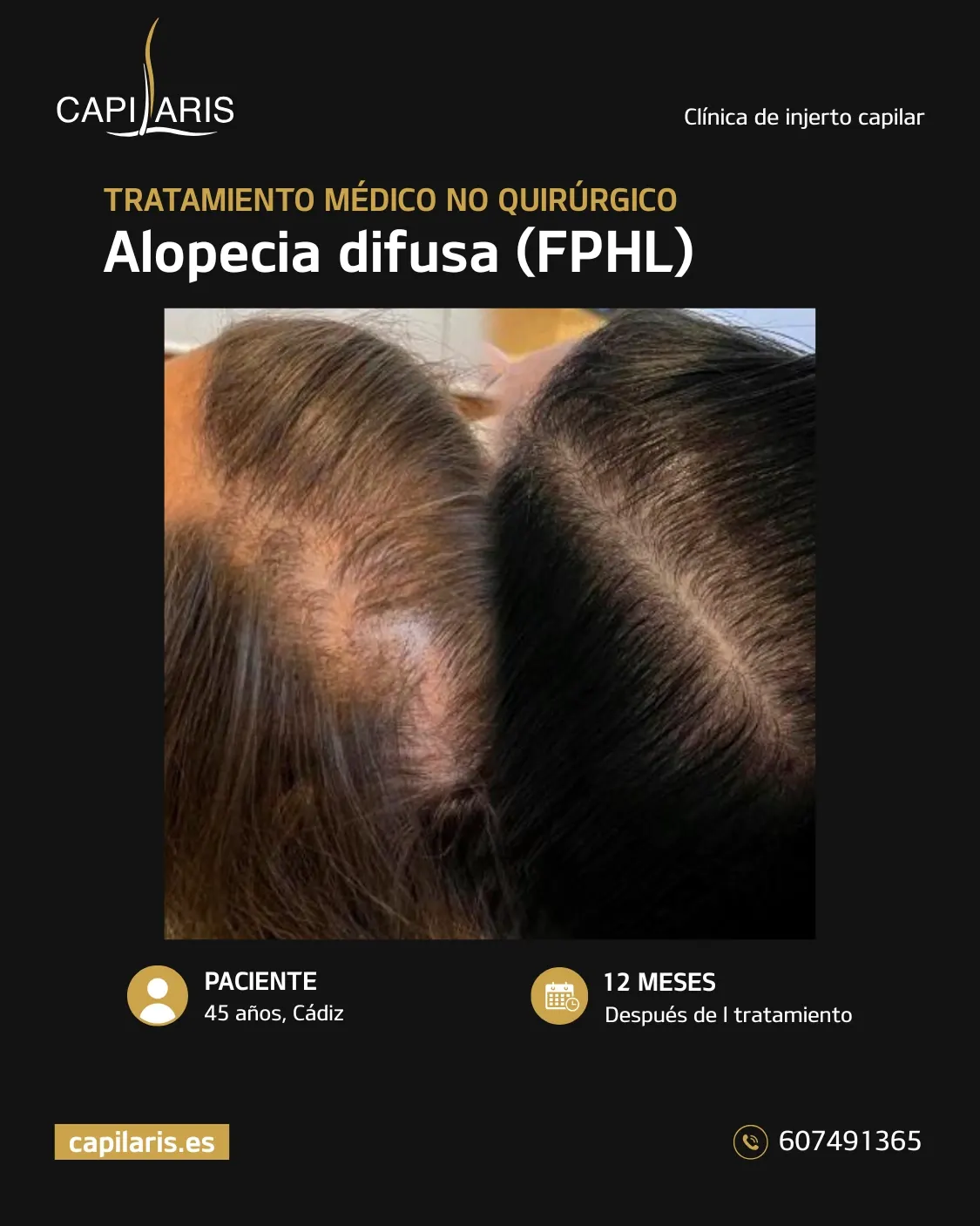 mesoterapia capilar marbella opiniones