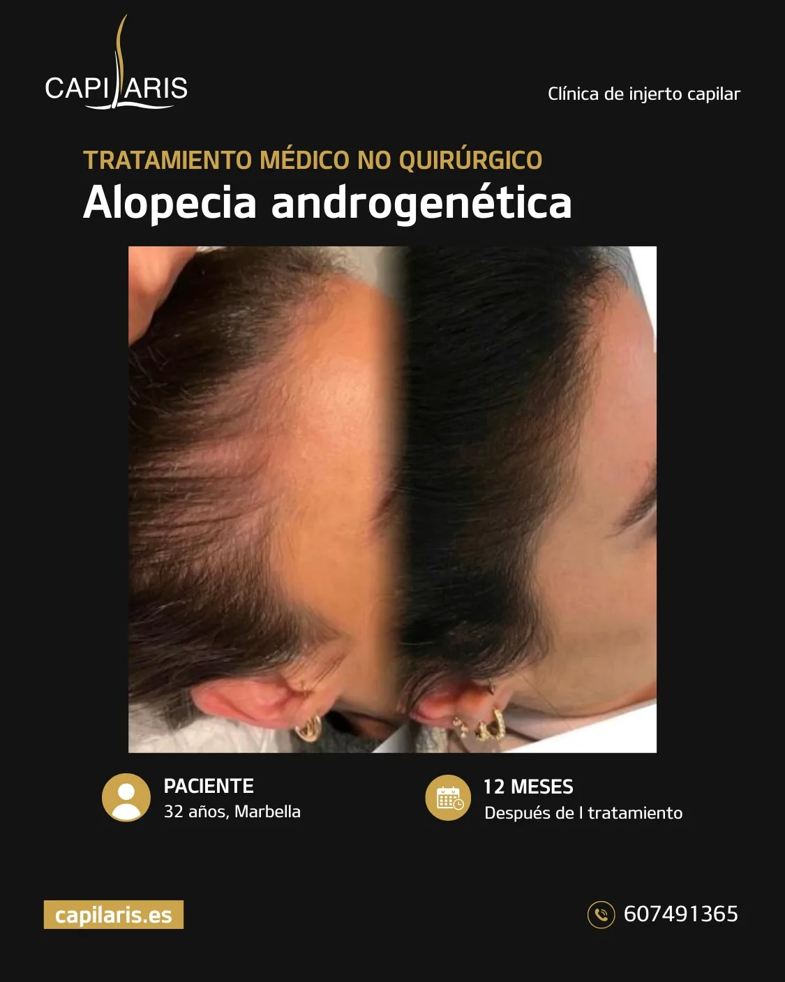 mesoterapia capilar en marbella