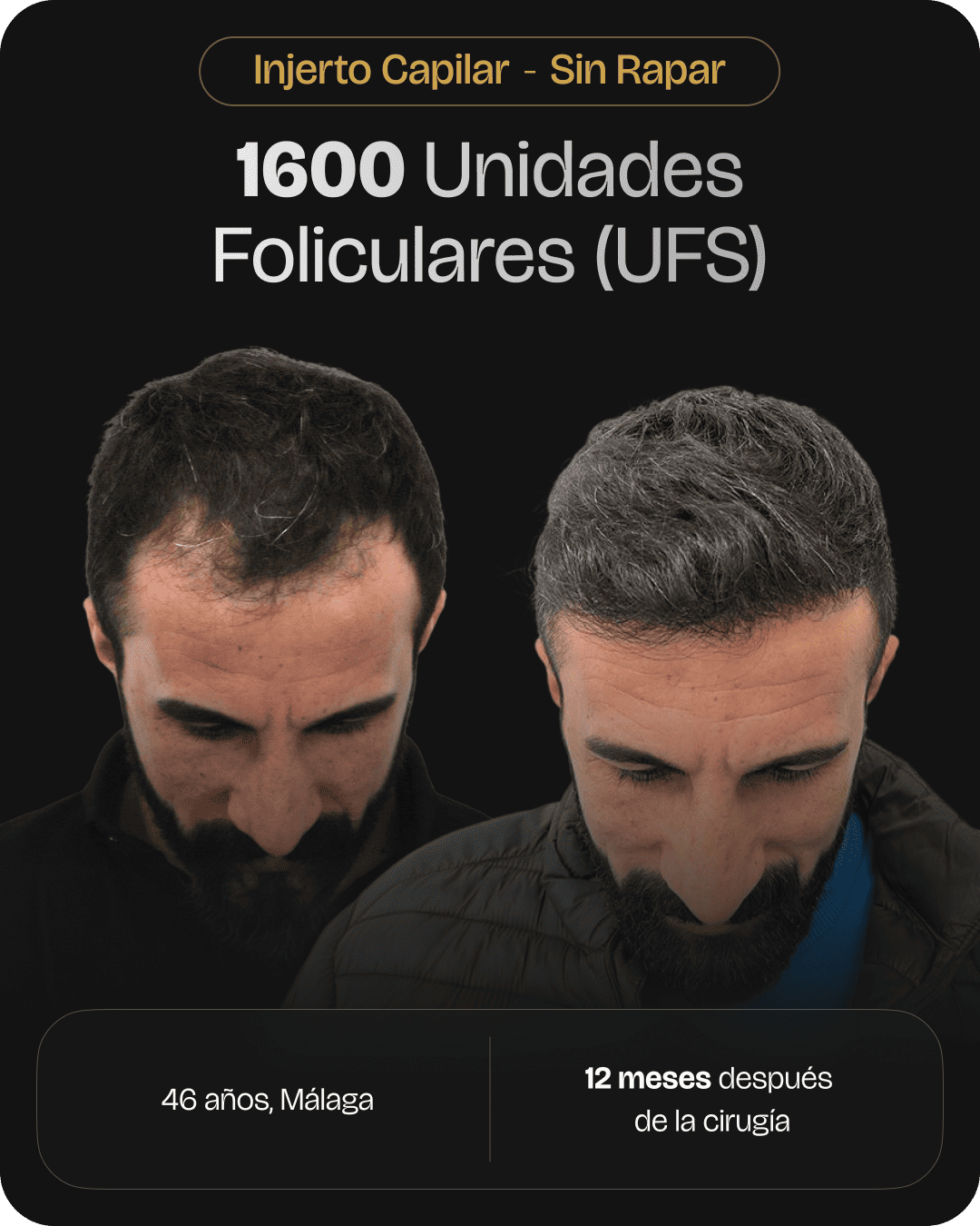 CAPILARIS - before-after-web-caso-11