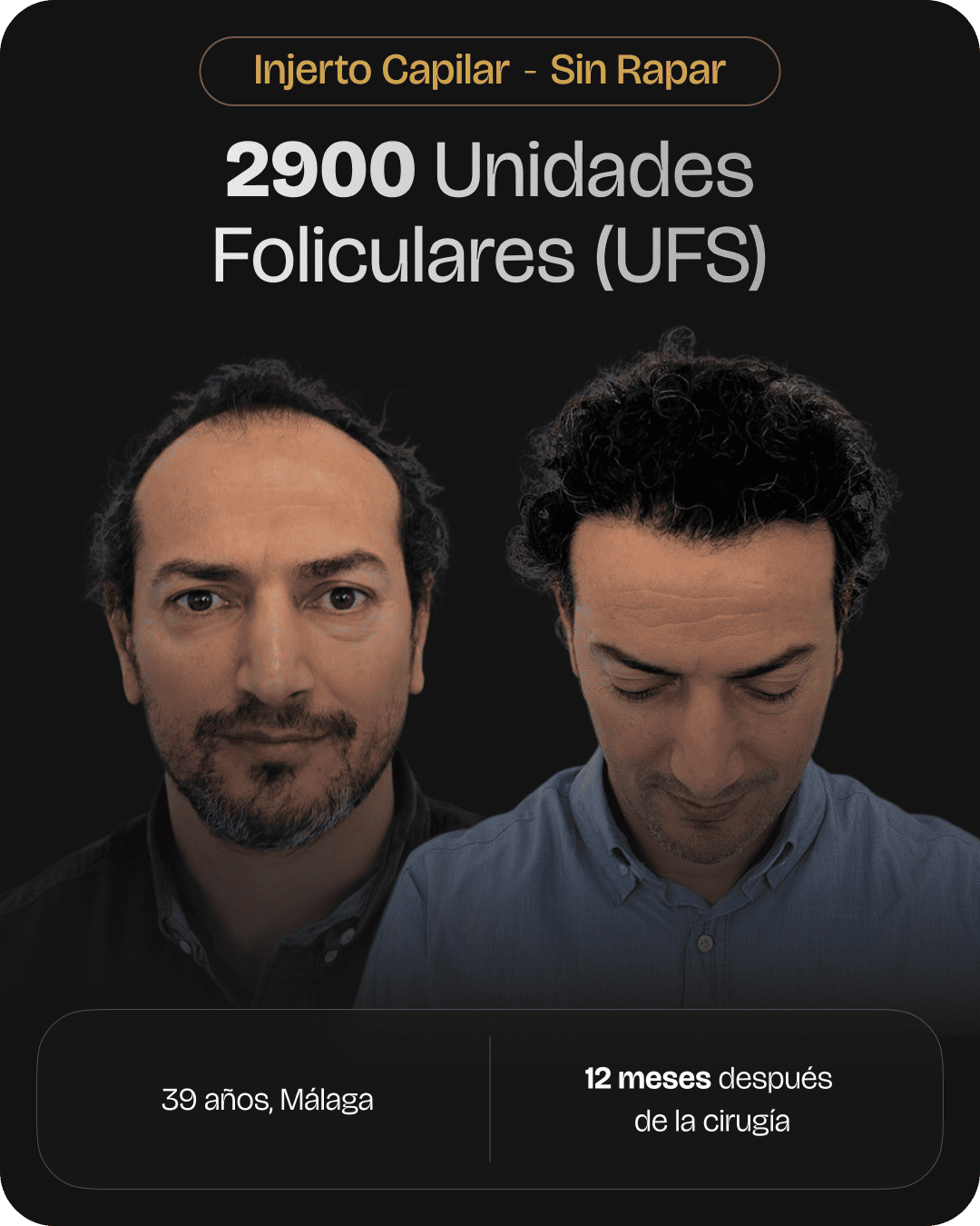 CAPILARIS - before-after-web-caso-12