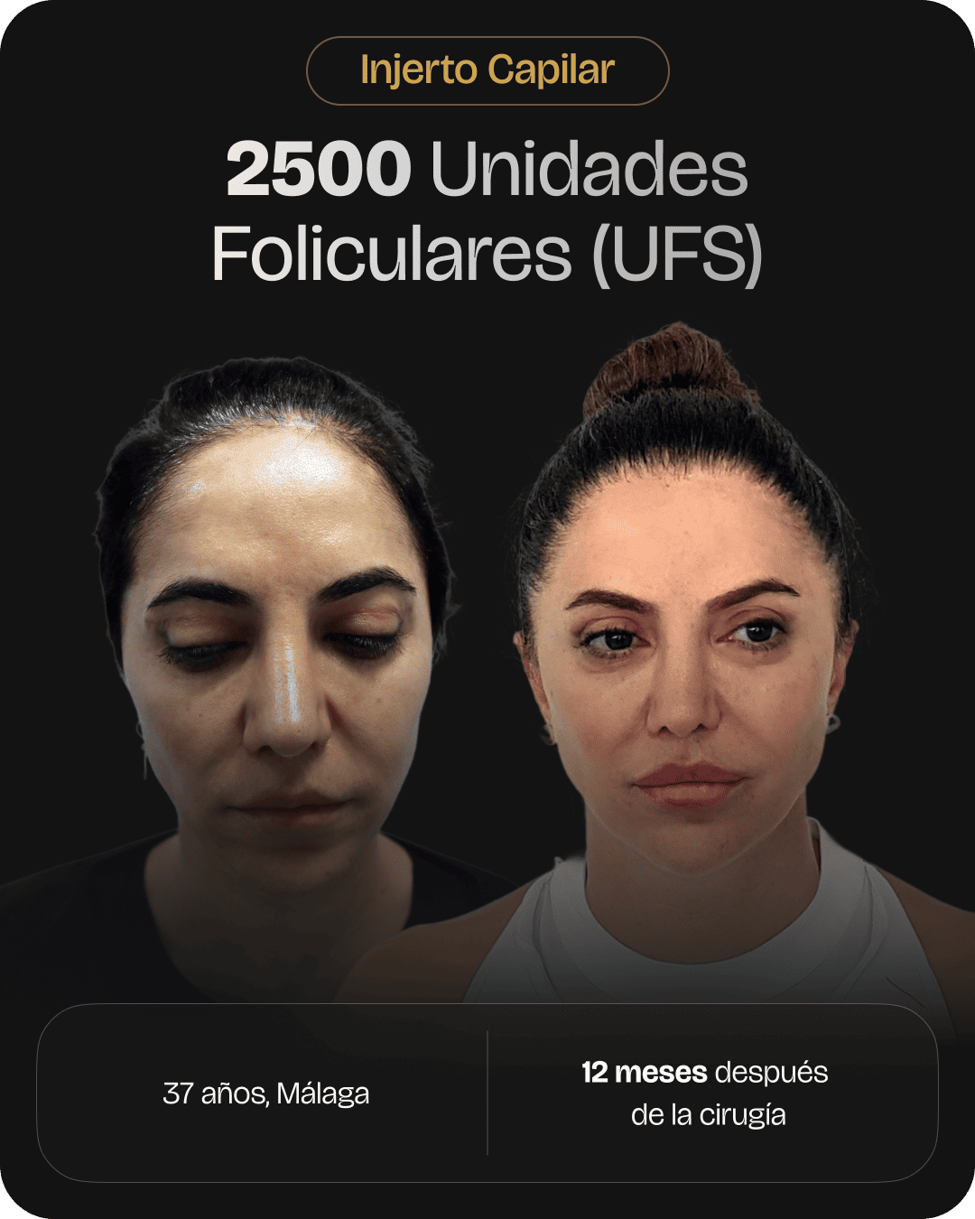 CAPILARIS - before-after-web-caso-13