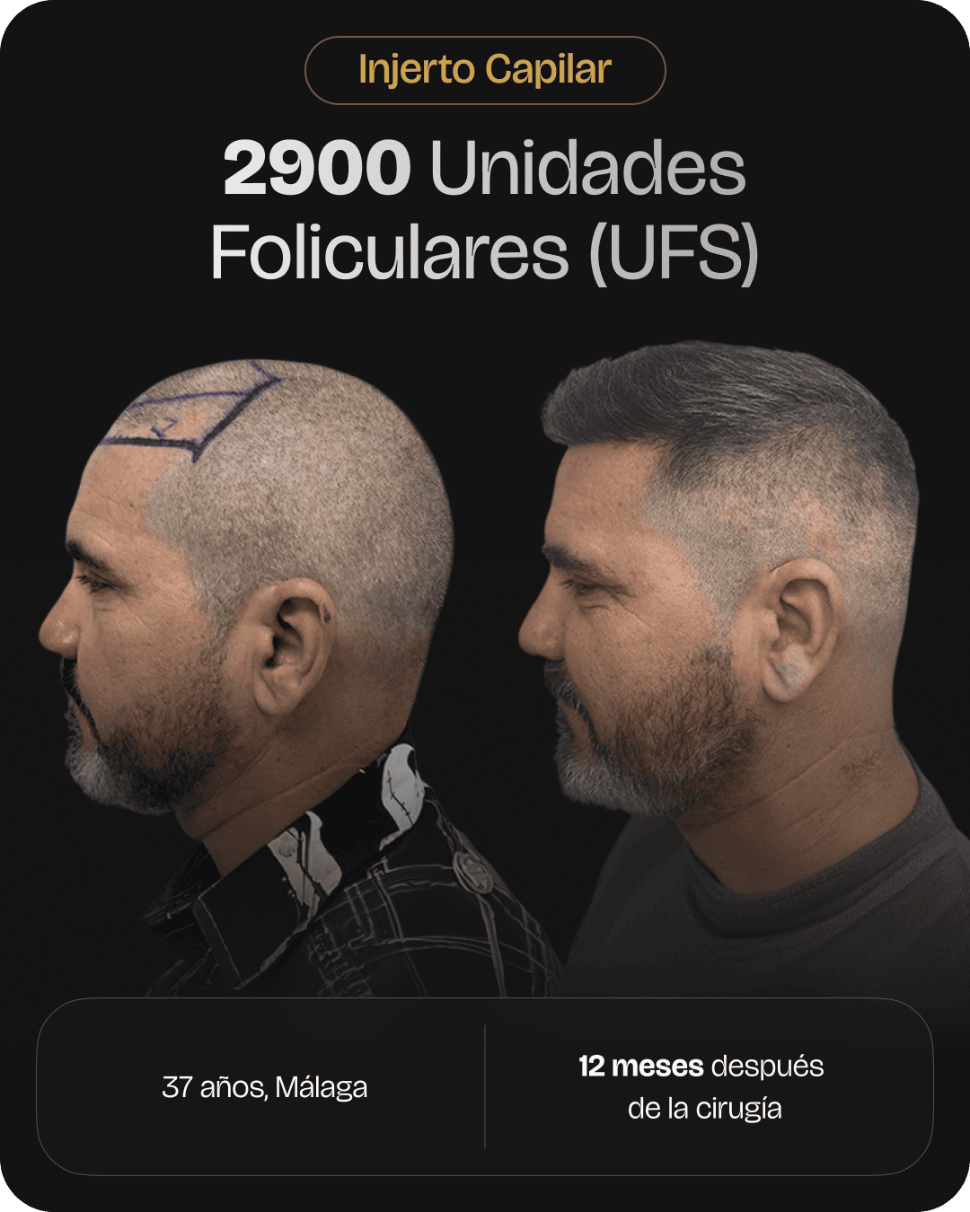 CAPILARIS - before-after-web-caso-2