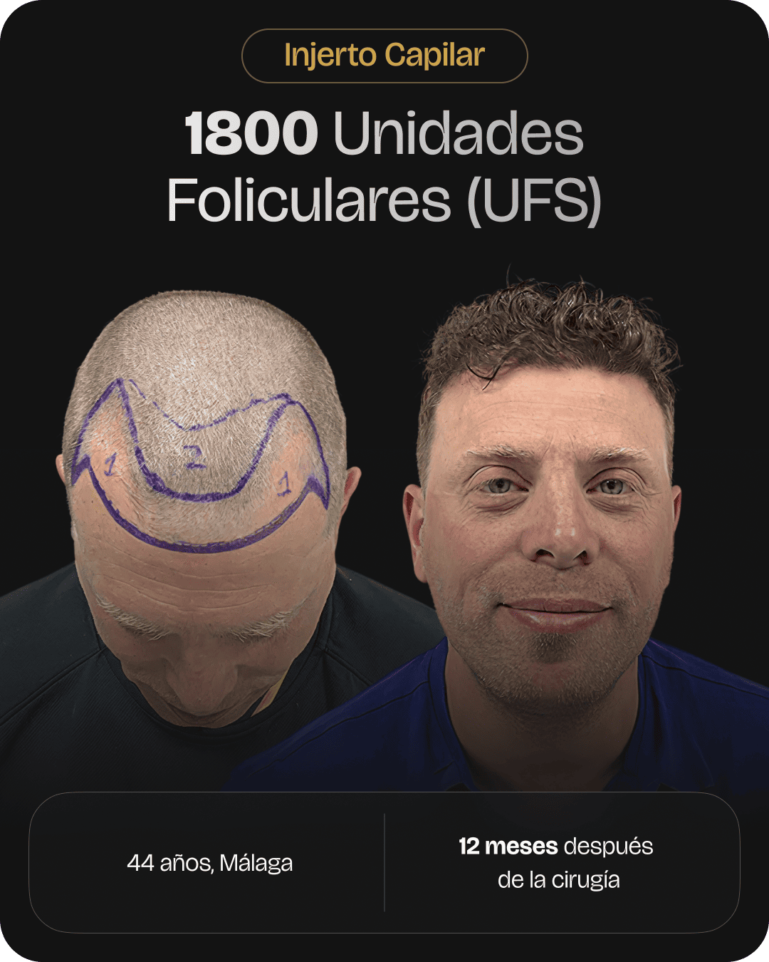 CAPILARIS - before-after-web-caso-8