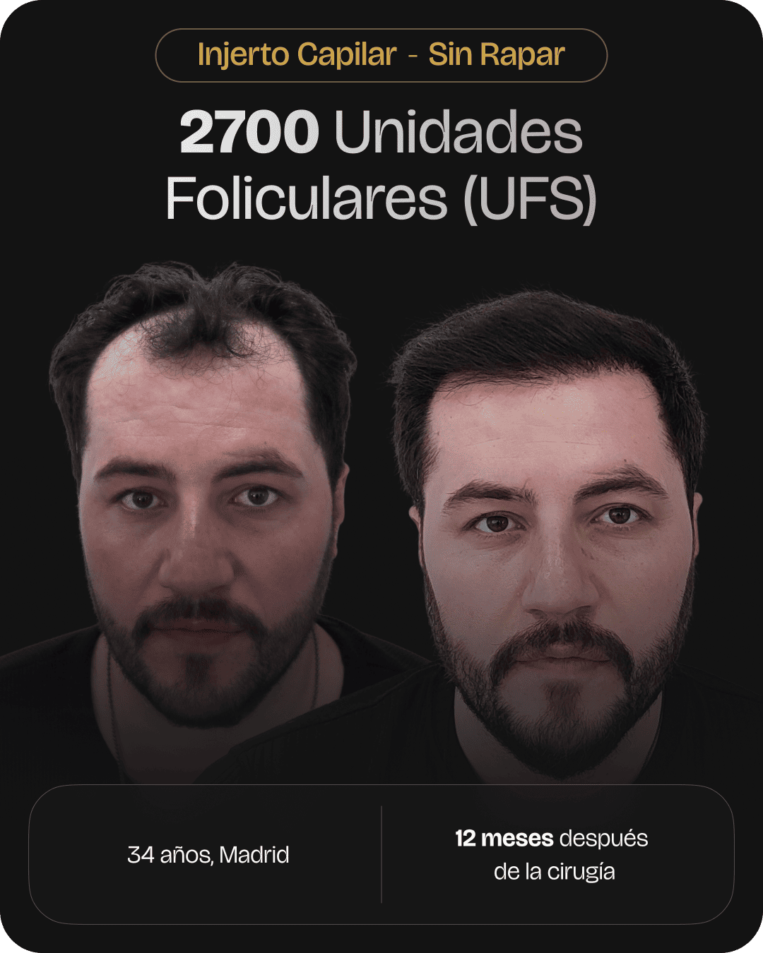 CAPILARIS - before-after-web-caso-9